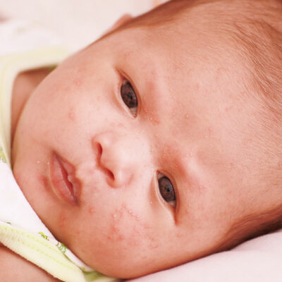 Atopic dermatitis in infants – Signs and management tips